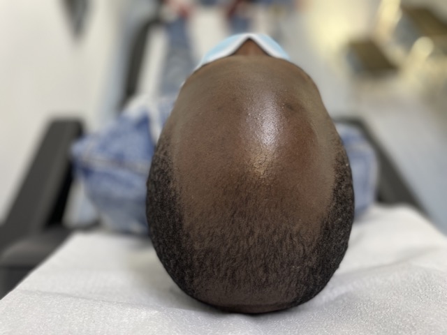alopecia en piel morena